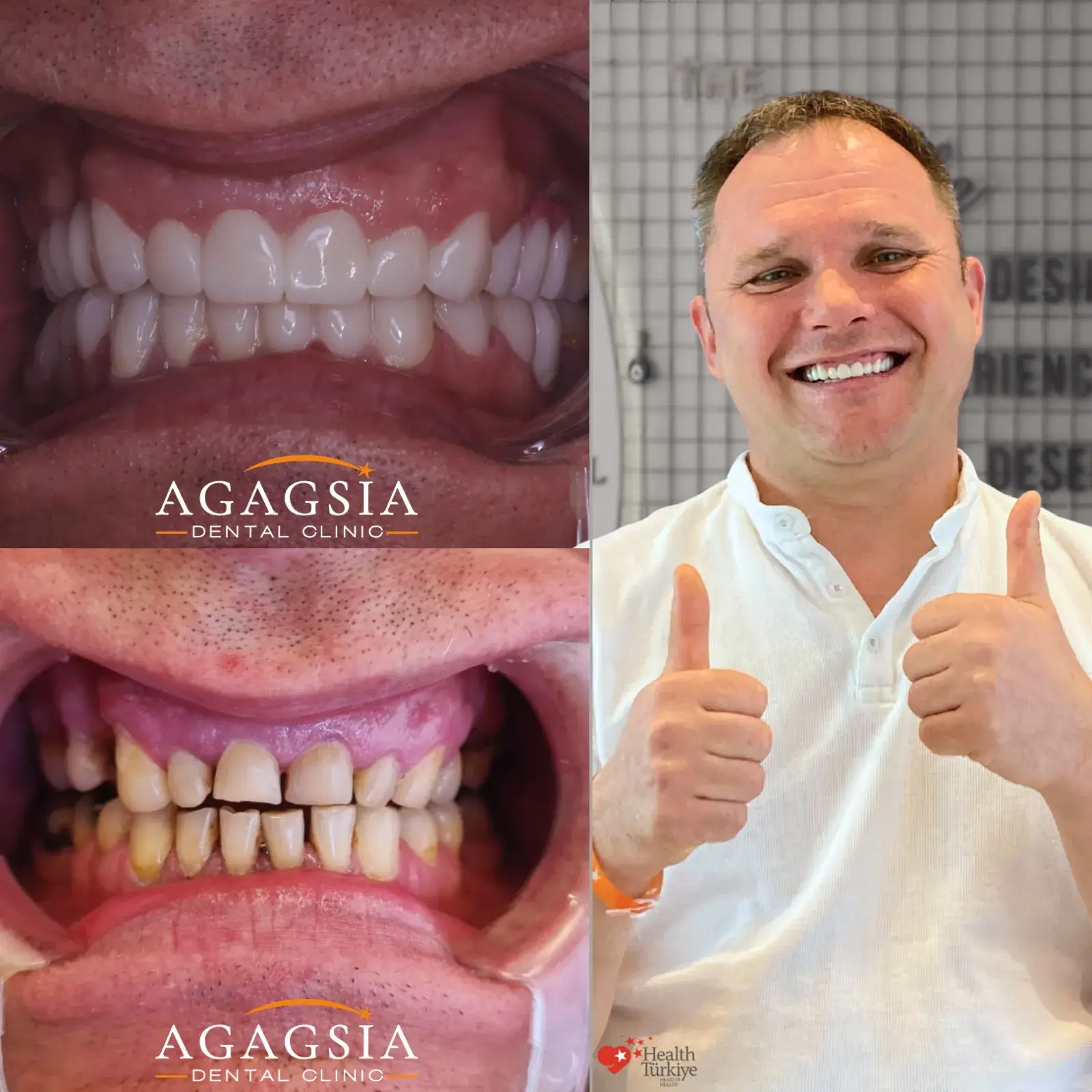 До и после – Smile Makeover