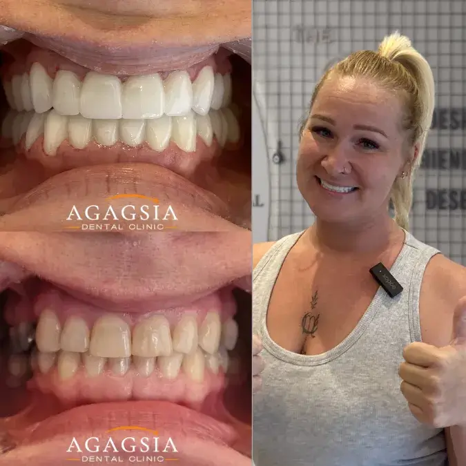 До и после – Smile Makeover
